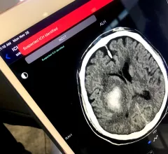 An example of artificial intelligence (AI) automated detection of a intracranial hemorrhage (ICH) in. a CT scan used to send alerts to the stroke acute care team before a radiologist even sees the exam. Example shown by TeraRecon at RSNA 2022.