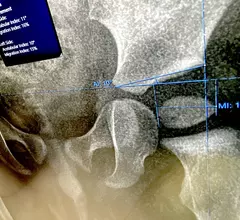 Automated AI measurements for Pediatric X-ray for hip dysplasia, Sectra HIMSS23.