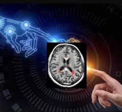 Charles E. Kahn, Jr., MD, MS, editor of the the RSNA journal Radiology: Artificial Intelligence, and professor and vice chair of radiology at the University of Pennsylvania Perelman School of Medicine. He discusses the need to validate artificial intelligence (AI) algorithms with your own patient population to determine if it is accurate for a specific institutions patients. He also explains how bias can be inadvertently added into a algorithm, and how the AI may take learning shortcuts. #AI