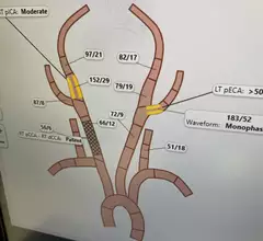 An interactive diagram for the carotids and arteries of the brain for interventional reporting shown by Fujifilm at HIMSS 2023. Photo by Dave Fornell