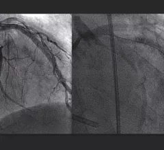 A comparison between a traditional iodine contrast angiogram (left), and a gadolinium contrast angiogram (right). MRI gadolinium contrast is starting to be used in some interventional radiology procedures and is being considered in interventional cardiology due to the iodine contrast shortage.