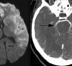 Ischemic stroke CT imaging. Images courtesy of RSNA