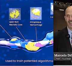 Marcelo DiCarli, MD, chief, division of nuclear medicine and molecular imaging, executive director for the cardiovascular imaging program, Brigham and Women's Hospital, discusses how artificial intelligence (AI) is impacting cardiac imaging.