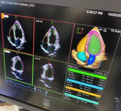 Example of a totally AI driven echocardiography workflow on the new Siemens Origin ultrasound system unveiled in 2023. The AI did all the work on this screen, taking a 3D echo exam and automatically segmenting the anatomy, contoured all the chambers, found the ideal views to display and then calculated all the measurements in seconds. Photo by Dave Fornell at TCT 2023. 