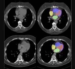 Advanced artificial intelligence (AI) models can evaluate cardiovascular risk in routine chest CT scans without contrast, according to new research published in Nature Communications.[1] In fact, the authors noted, the AI approach may be more effective at identifying issues than relying on guidance from radiologists. Representative non-contrast CT slices for two patients (left), with super-imposed segmentations (right). One artificial intelligence (AI) model was used to segment a cardiac mask.